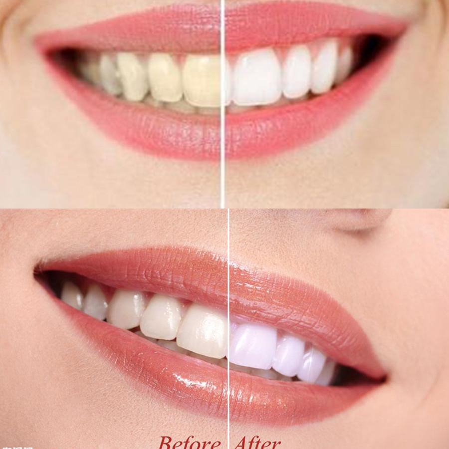 Denti di carbone di bambù dent - Teeth Whitening Ulta recensione e prezzo