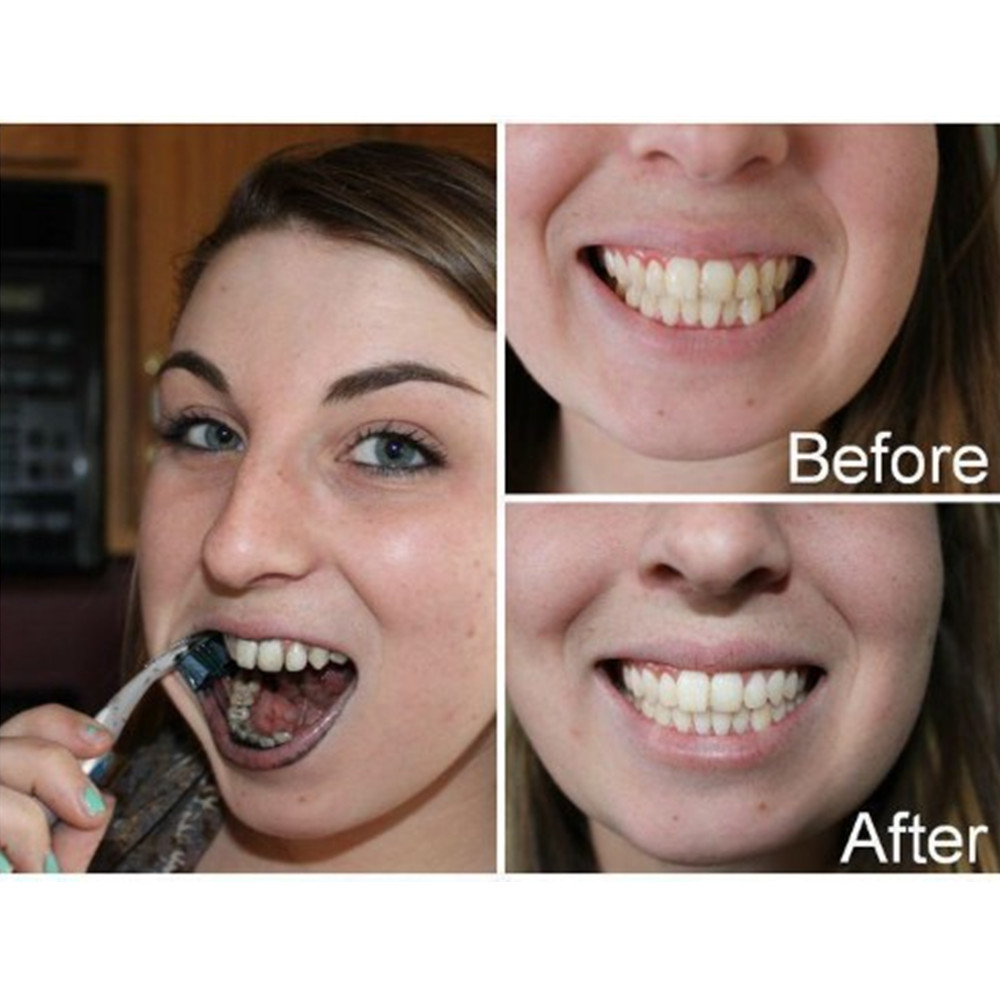 Denti di carbone di bambù dent - Teeth Whitening Ulta recensione e prezzo