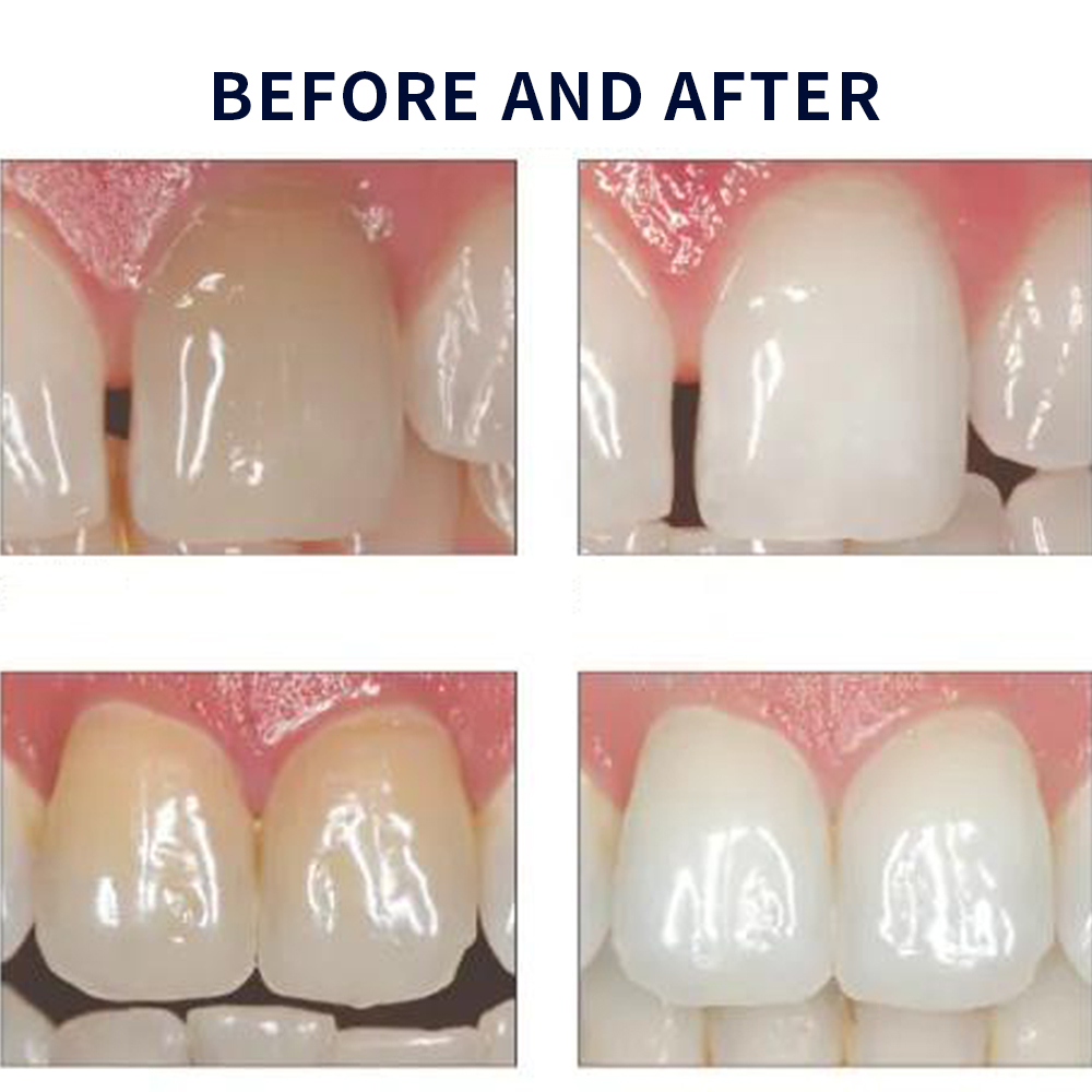 Opalescence Whitening 20% PF 2 - Teeth Whitening Hydrogen Peroxide recensione e prezzo