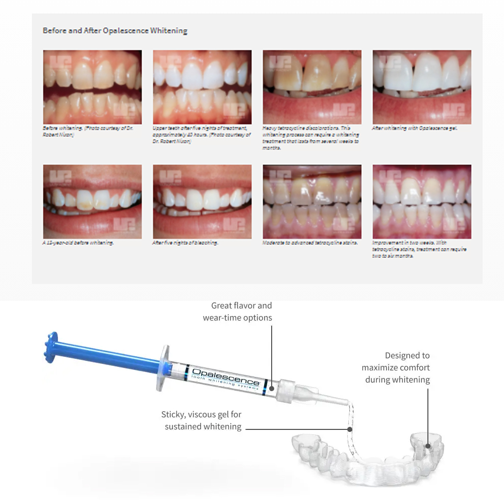 Opalescence Whitening 20% PF 2 - Teeth Whitening Hydrogen Peroxide recensione e prezzo